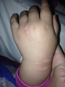 Bed bug bite on my Elder Daughter's arm 002